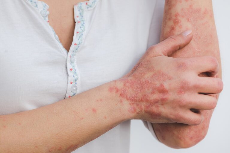 psoriasis, skin, disease-5996424.jpg